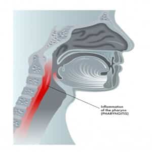 Hoarseness