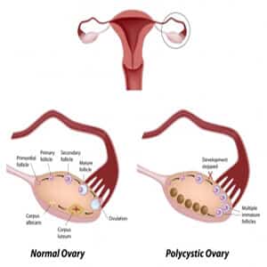 Polycystic-ovary