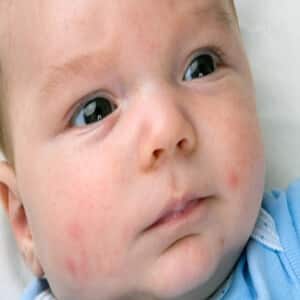 Rubella