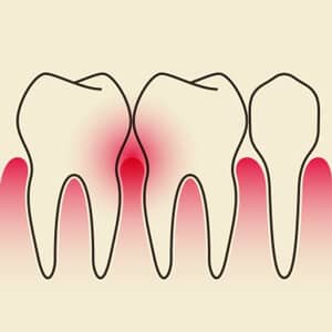 gingivitis